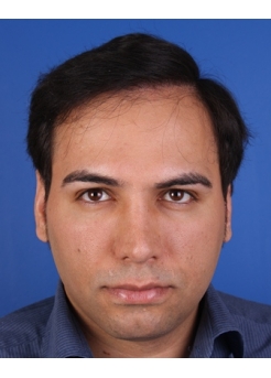 After Hair Transplant&nbsp;Front